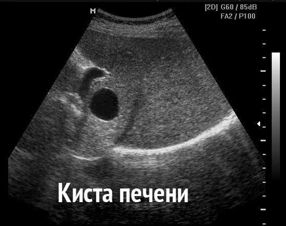 Вид печени с кистой