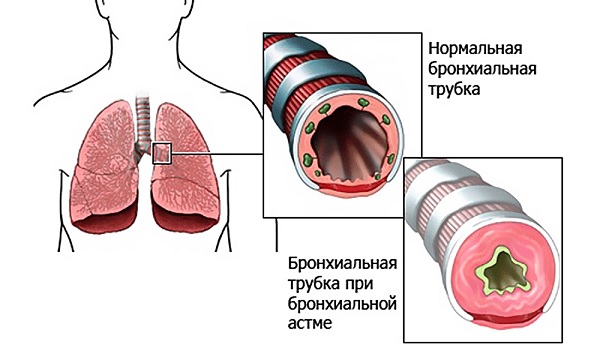 Bronhi