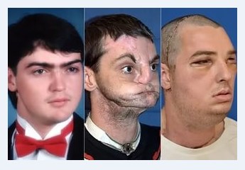 Успешная операция по пересадке лица