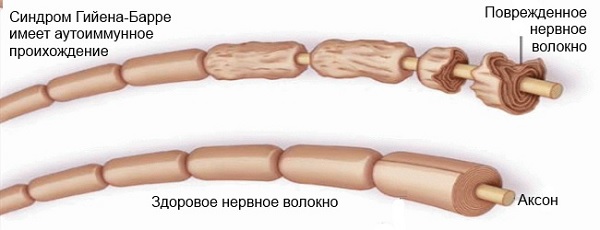Нервы пораженные синдромом