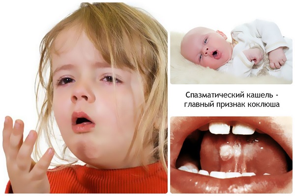 Симптомы коклюша
