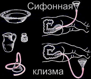 Постановка сифонной клизмы