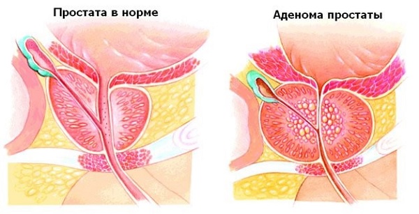 Аденома