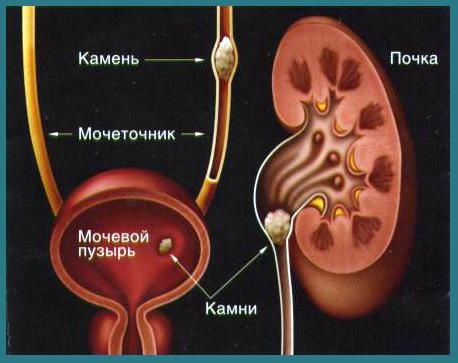 Камни в почках