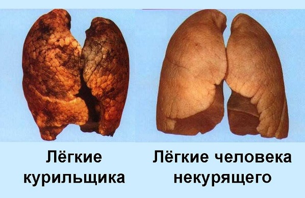 Легкие курильщика и некурящего
