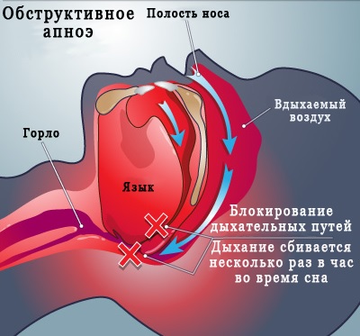Апноэ-основная причина лунатизма