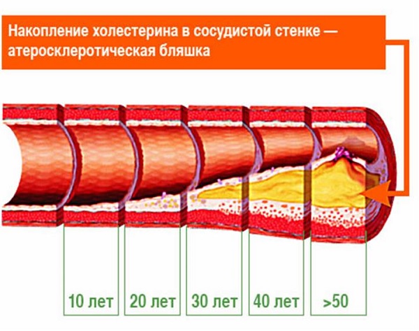 Уровень холестерина в сосудах