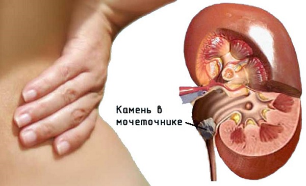 Камни в мочеточниках