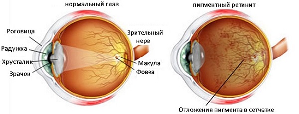 Ретинит пигментный очень опасен