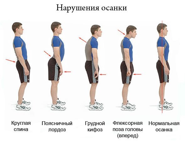 Нарушения осанки
