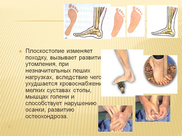Профилактика плоскостопия у взрослых