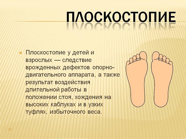 Профилактика плоскостопия у взрослых