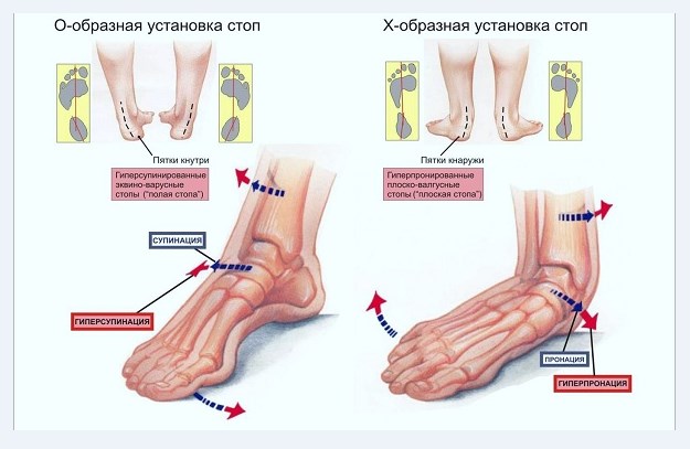 Плоскостопие у взрослых