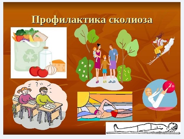 Профилактика сколиоза у взрослых