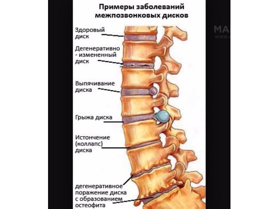 Болезни позвоночника