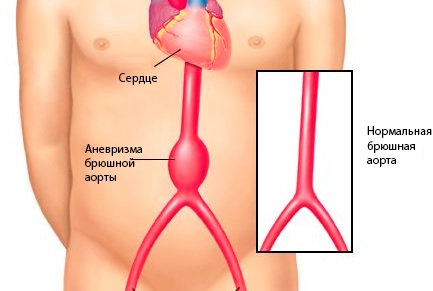 Здоровая и больная аорта
