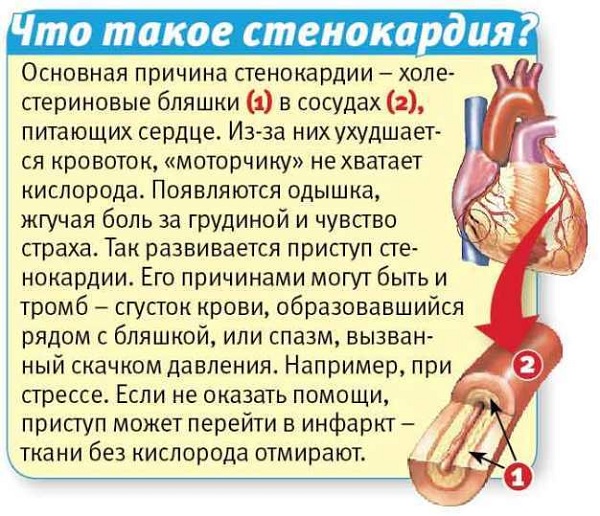 Стенокардия 