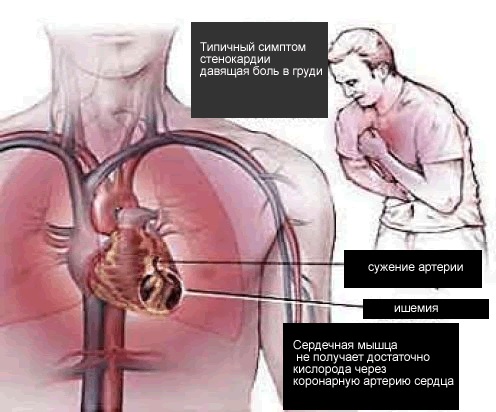 Ишемия и стенокардия