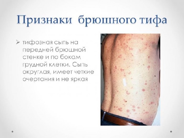 Признаки брюшного тифа на теле