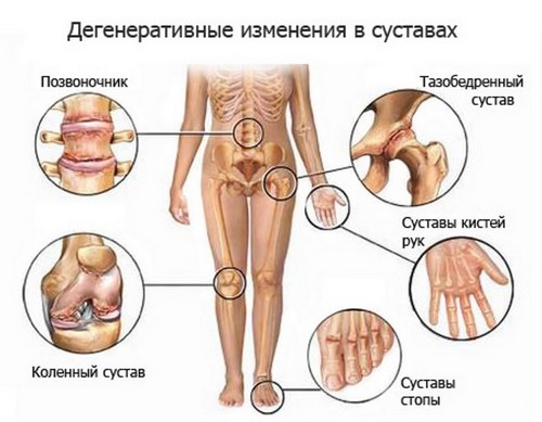 Болезни суставов