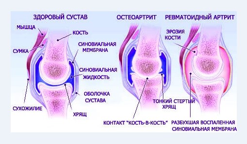 Проблемы с суставами