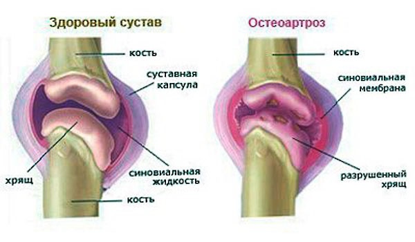 Синовиальная жидкость в суставе