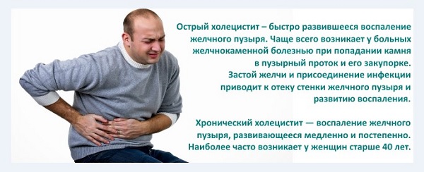 Острый холецистит 