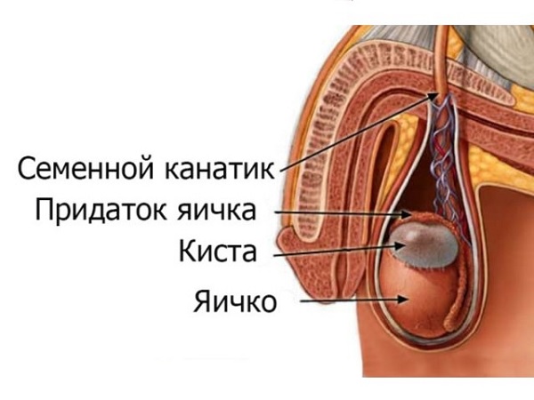Киста в яичке у мужчины