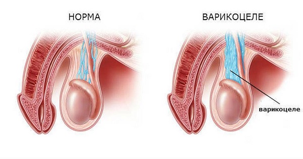 Норма и варикоцеле