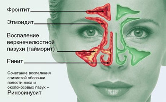 Риносинусит