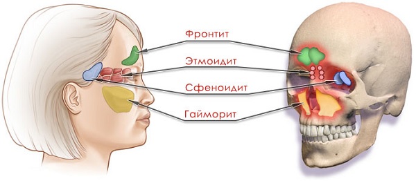 Синупрет и его аналоги что дешевле