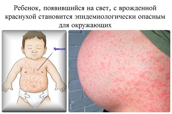 Краснуха во время беременности