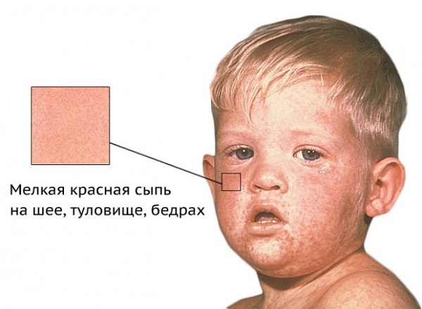 Симптомы краснухи