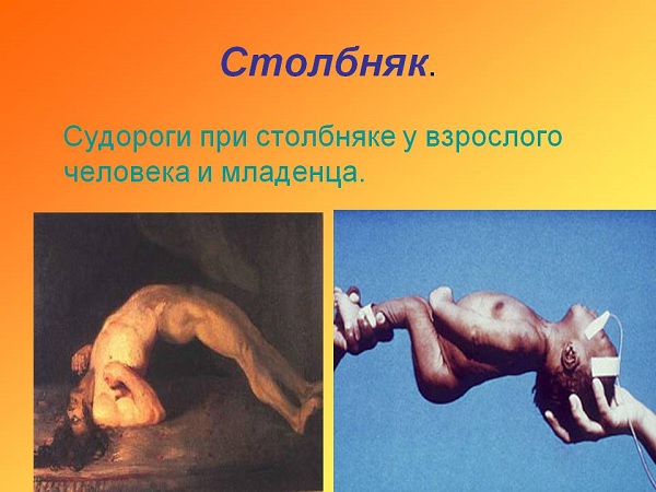 Столбняк