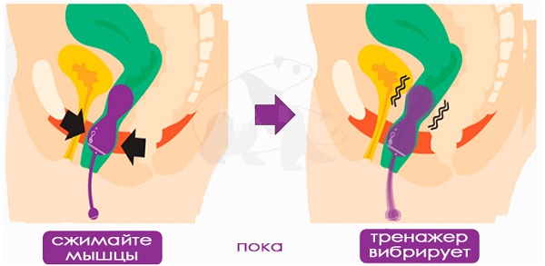Перинометр в работе