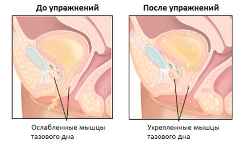 До и после упражнений Кегеля