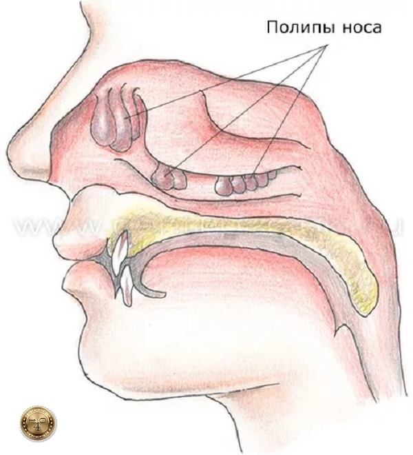 полипы в носу