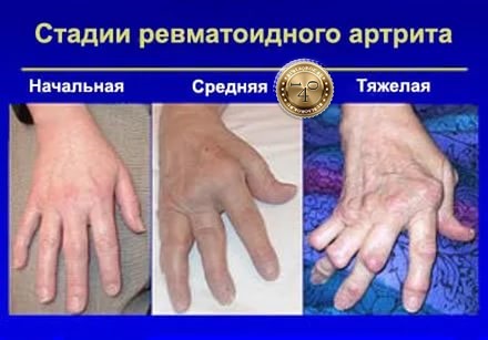 стадии ревматоидного артрита