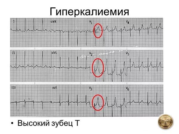 кардиограмма с гиперкалиемией