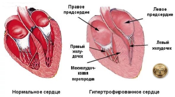 больное сердце