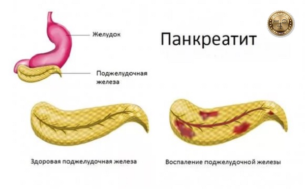обострение панкреатита