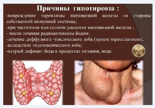Основные причины гипотериоза