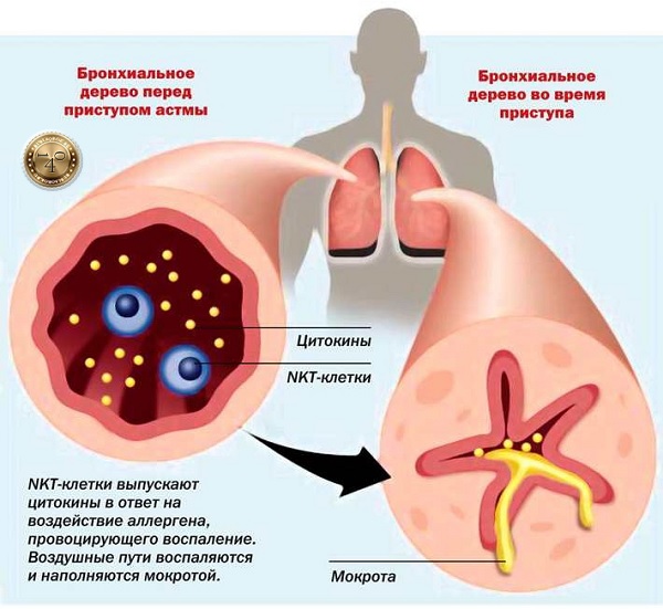 бронхиальная астма