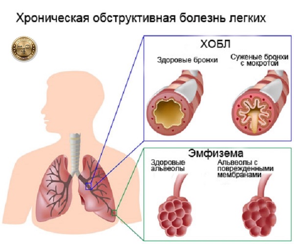 обструктивная болезнь легких