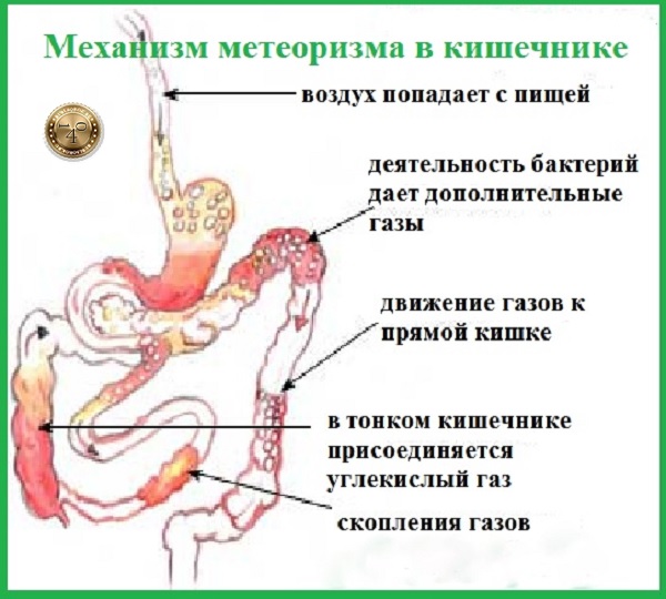 причины метеоризма