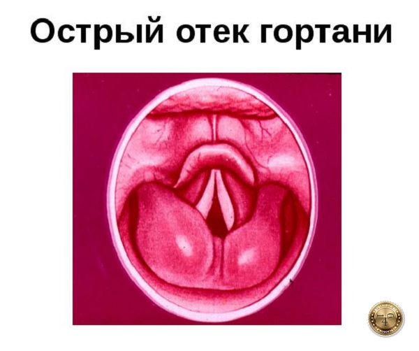 отек гортани