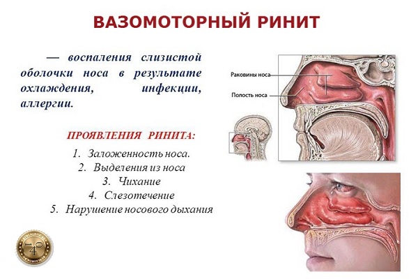 вазомоторный ринит
