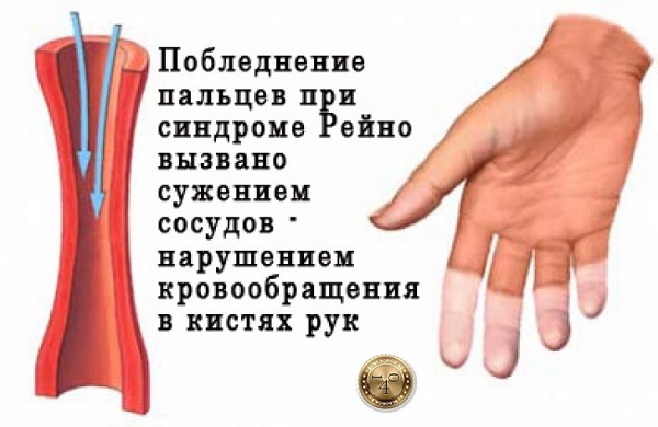 вид болезни Рейно