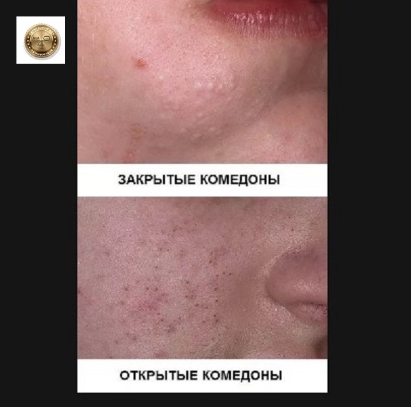 камедоны