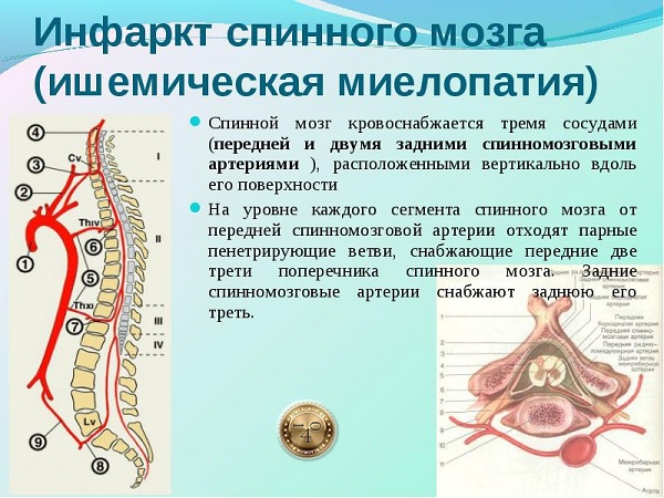 ишемическая миелопатия